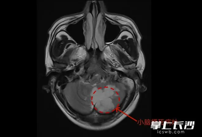 男子头晕问AI，判断为“眩晕症”，三天后竟查出脑梗死！