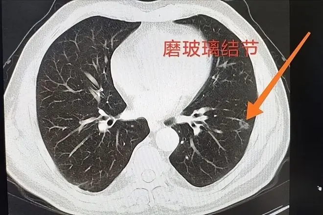 黄瓜被点名了!发现:肺结节病人吃黄瓜,不必等多久,或有5变化
